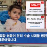결합 쌍둥이 분리 수술 시애틀 병원에서 이루어집니다