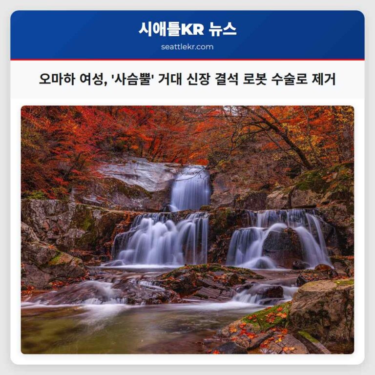 오마하 여성 사슴뿔 크기의 거대 신장 결석 로봇 수술로 성공적으로 제거